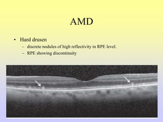 AMD
• Hard drusen
– discrete nodules of high reflectivity in RPE level.
– RPE showing discontinuity
 