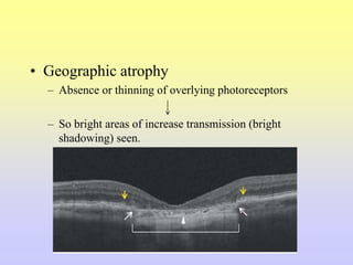 • Geographic atrophy
– Absence or thinning of overlying photoreceptors
– So bright areas of increase transmission (bright
shadowing) seen.
 