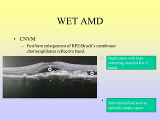 WET AMD
• CNVM
– Fusiform enlargement of RPE/Bruch’s membrane/
choriocapillaries reflective band.
Duplication with high
scattering material b/w 2
bands
Sub-retinal fluid seen as
optically empty space.
 