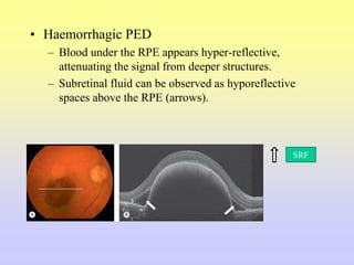 • Haemorrhagic PED
– Blood under the RPE appears hyper-reflective,
attenuating the signal from deeper structures.
– Subretinal fluid can be observed as hyporeflective
spaces above the RPE (arrows).
SRF
 