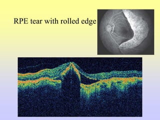RPE tear with rolled edge
 