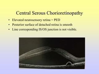 Central Serous Chorioretinopathy
• Elevated neurosensory retina + PED
• Posterior surface of detached retina is smooth
• Line corresponding IS/OS junction is not visible.
 