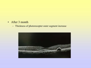 • After 3 month
– Thickness of photorecepter outer segment increase
 
