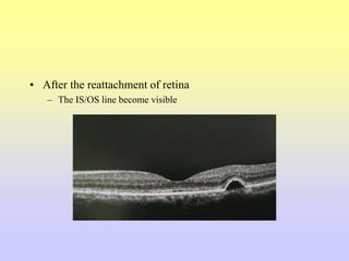 • After the reattachment of retina
– The IS/OS line become visible
 
