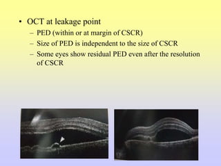 • OCT at leakage point
– PED (within or at margin of CSCR)
– Size of PED is independent to the size of CSCR
– Some eyes show residual PED even after the resolution
of CSCR
 