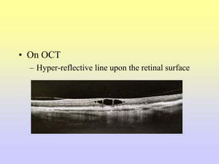• On OCT
– Hyper-reflective line upon the retinal surface
 