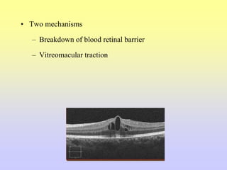 • Two mechanisms
– Breakdown of blood retinal barrier
– Vitreomacular traction
 