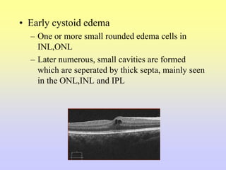 • Early cystoid edema
– One or more small rounded edema cells in
INL,ONL
– Later numerous, small cavities are formed
which are seperated by thick septa, mainly seen
in the ONL,INL and IPL
 