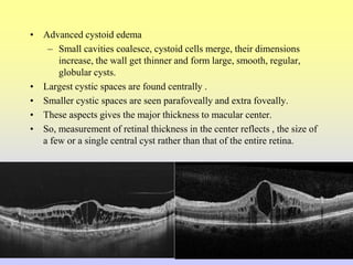 • Advanced cystoid edema
– Small cavities coalesce, cystoid cells merge, their dimensions
increase, the wall get thinner and form large, smooth, regular,
globular cysts.
• Largest cystic spaces are found centrally .
• Smaller cystic spaces are seen parafoveally and extra foveally.
• These aspects gives the major thickness to macular center.
• So, measurement of retinal thickness in the center reflects , the size of
a few or a single central cyst rather than that of the entire retina.
 