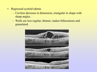 • Regressed cystoid edema
– Cavities decrease in dimension, triangular in shape with
sharp angles.
– Walls are less regular, thinner, makes bifurcations and
granulated.
 