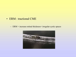 • ERM : tractional CME
– ERM + increase retinal thickness+ irregular cystic spaces
 