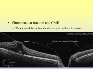 • Vitreomacular traction and CME
– The tractional forces from the vitreous lead to edema formation.
 