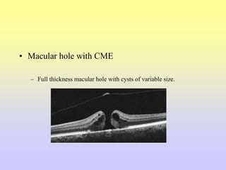 • Macular hole with CME
– Full thickness macular hole with cysts of variable size.
 