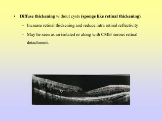 • Diffuse thickening without cysts (sponge like retinal thickening)
– Increase retinal thickening and reduce intra retinal reflectivity
– May be seen as an isolated or along with CME/ serous retinal
detachment.
 