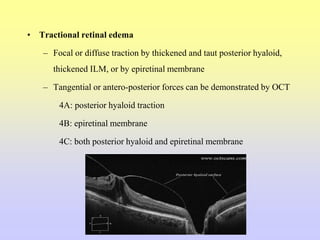 • Tractional retinal edema
– Focal or diffuse traction by thickened and taut posterior hyaloid,
thickened ILM, or by epiretinal membrane
– Tangential or antero-posterior forces can be demonstrated by OCT
4A: posterior hyaloid traction
4B: epiretinal membrane
4C: both posterior hyaloid and epiretinal membrane
 