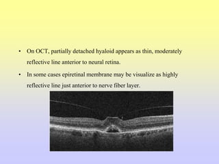 • On OCT, partially detached hyaloid appears as thin, moderately
reflective line anterior to neural retina.
• In some cases epiretinal membrane may be visualize as highly
reflective line just anterior to nerve fiber layer.
 