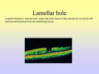 Lamellar hole
A partial thickness. macular hole, where the inner layers of the macula are involved with
traction and detached from the underlying layers.
 