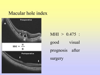 Macular hole index
MHI > 0.475 :
good visual
prognosis after
surgery
 