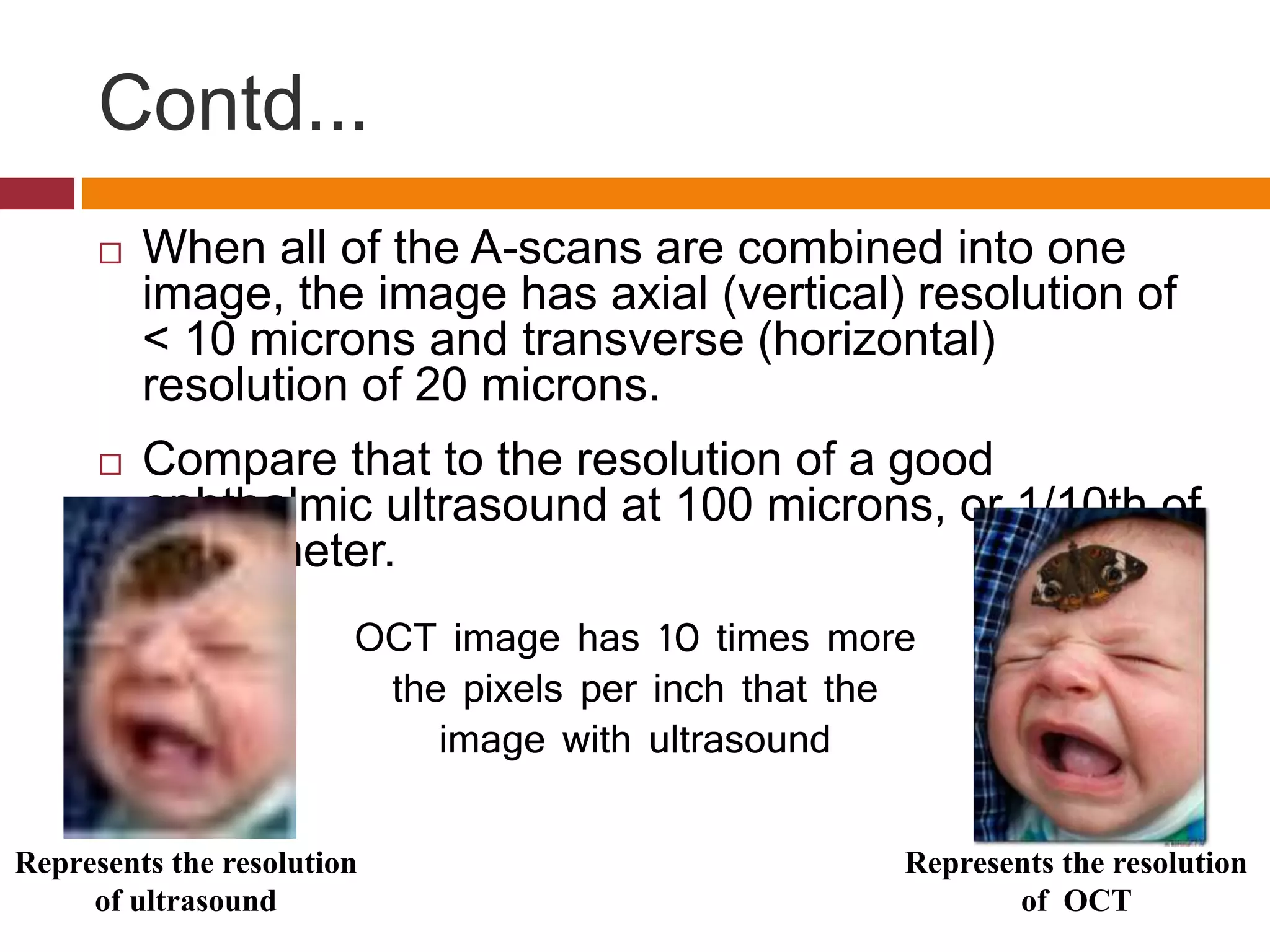 Contd...
 When all of the A-scans are combined into one
image, the image has axial (vertical) resolution of
< 10 microns and transverse (horizontal)
resolution of 20 microns.
 Compare that to the resolution of a good
ophthalmic ultrasound at 100 microns, or 1/10th of
a millimeter.
Represents the resolution
of ultrasound
Represents the resolution
of OCT
OCT image has 10 times more
the pixels per inch that the
image with ultrasound
 