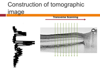 Transverse Scanning
Backscatter Intensity
Axial
Scanning
(Depth)
Construction of tomographic
image
 