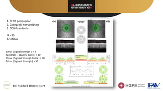 1. CFNR peripapilar
2. Cabeça do nervo óptico
3. CCG da mácula
IR – 30
Artefatos
Cirrus ( Signal Strengh ) > 6
Spectralis ( Quality Score ) > 20
Rtvue ( Signeal Strengh Index ) > 30
Triton ( Signeal Strengh ) > 50
 