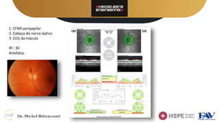 1. CFNR peripapilar
2. Cabeça do nervo óptico
3. CCG da mácula
IR – 30
Artefatos
 