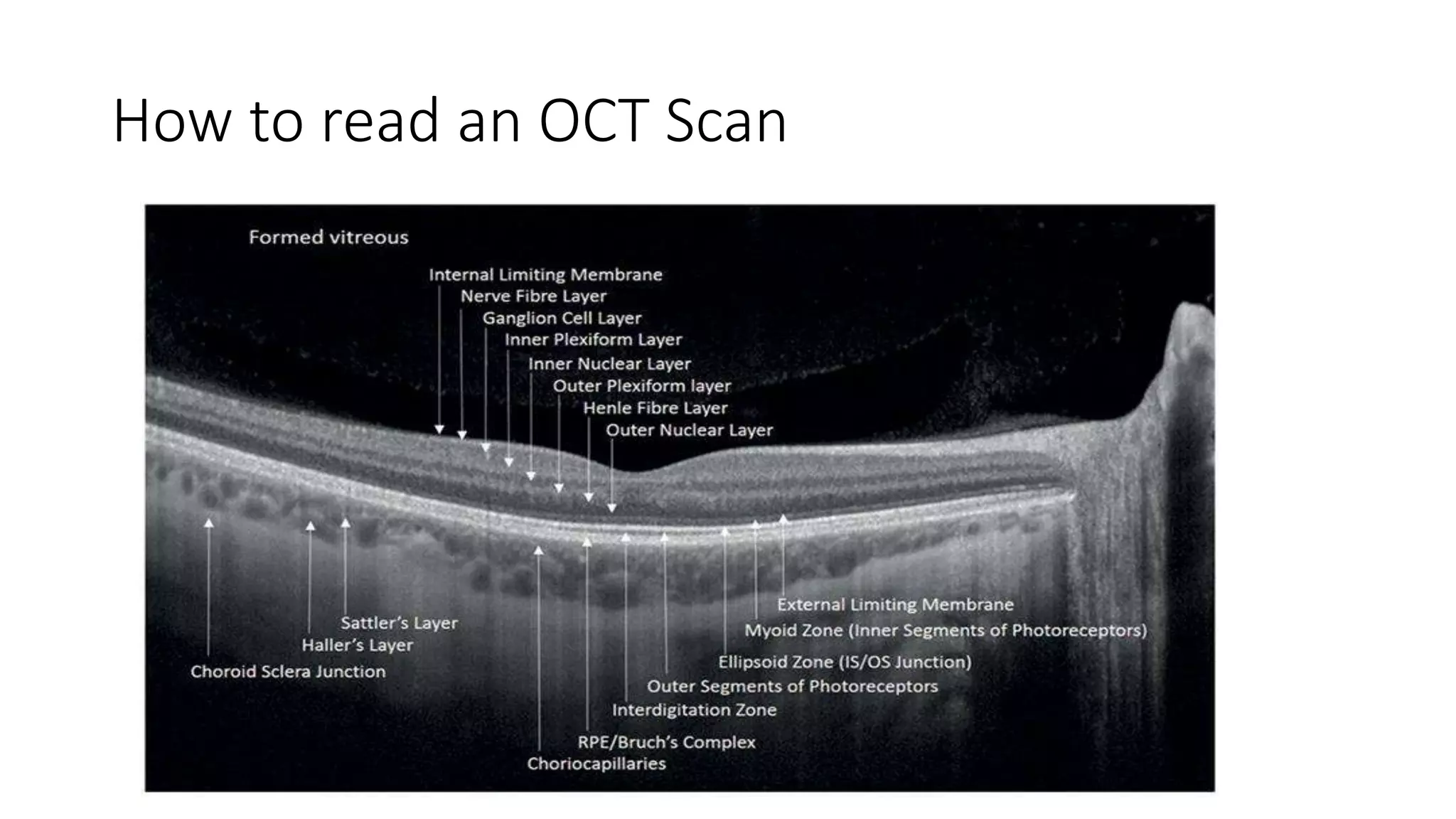How to read an OCT Scan
 