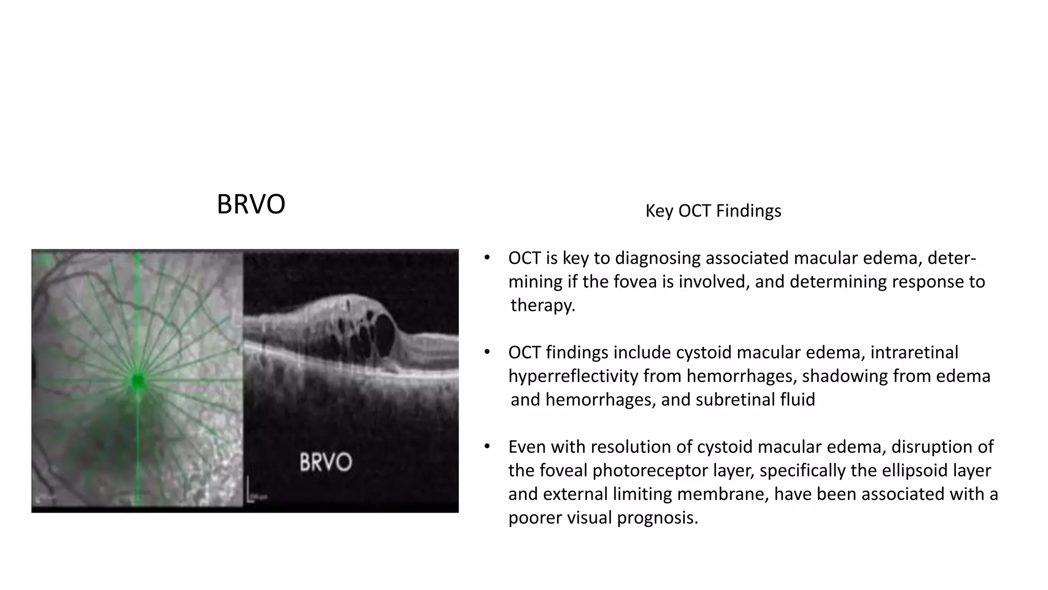 Key OCT Findings
• OCT is key to diagnosing associated macular edema, deter-
mining if the fovea is involved, and determining response to
therapy.
• OCT findings include cystoid macular edema, intraretinal
hyperreflectivity from hemorrhages, shadowing from edema
and hemorrhages, and subretinal fluid
• Even with resolution of cystoid macular edema, disruption of
the foveal photoreceptor layer, specifically the ellipsoid layer
and external limiting membrane, have been associated with a
poorer visual prognosis.
BRVO
 