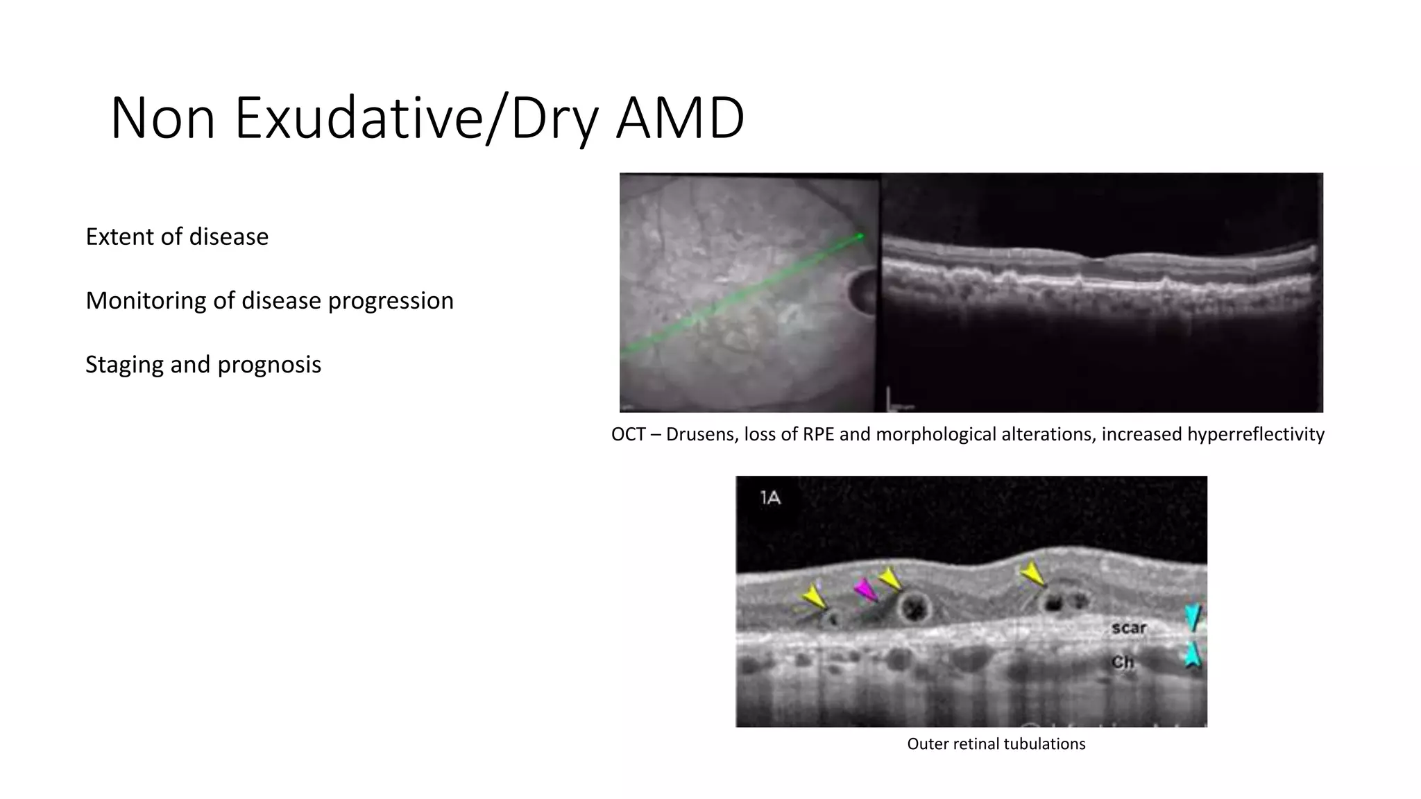 Non Exudative/Dry AMD
Extent of disease
Monitoring of disease progression
Staging and prognosis
OCT – Drusens, loss of RPE and morphological alterations, increased hyperreflectivity
Outer retinal tubulations
 
