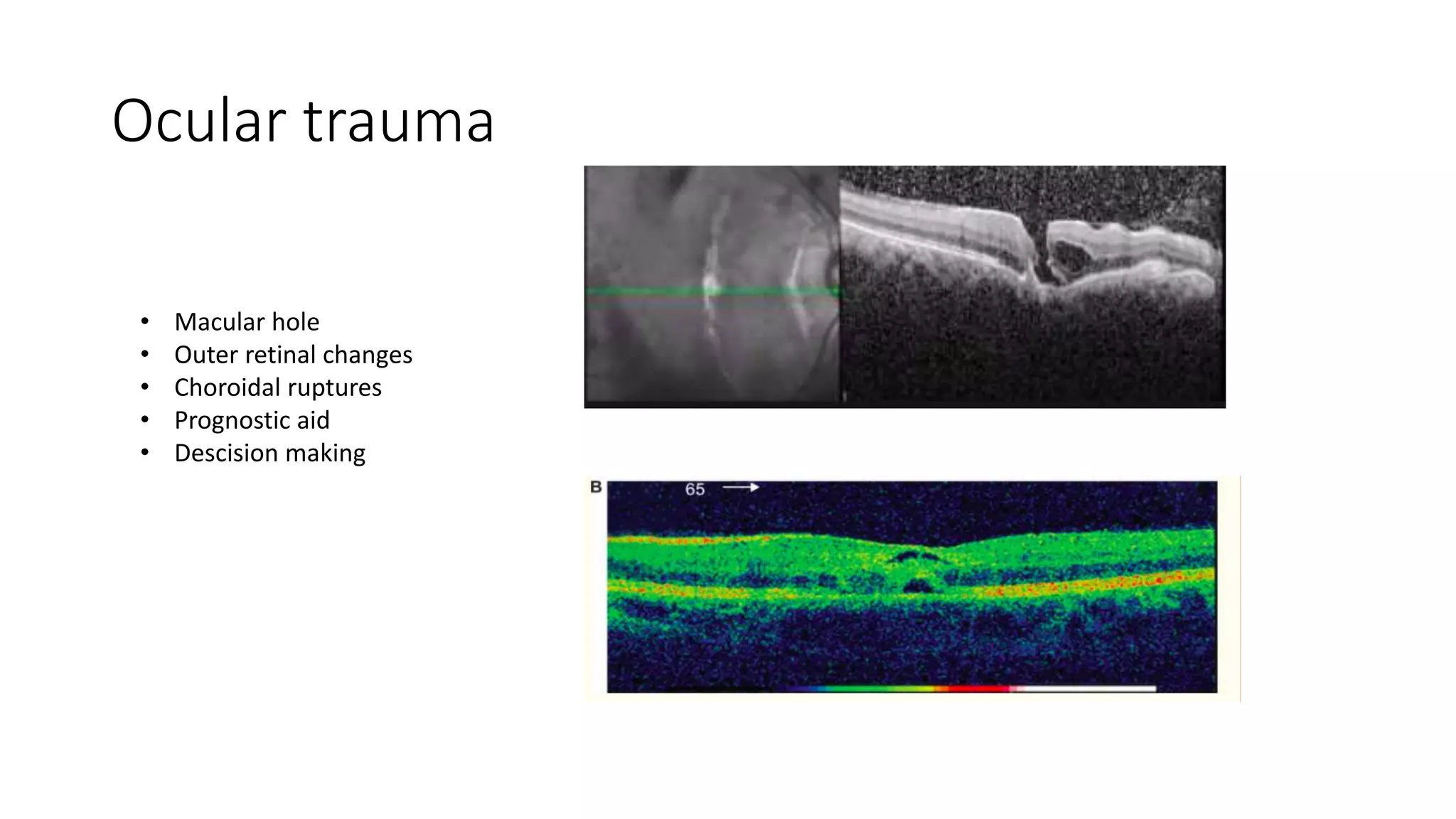 Ocular trauma
• Macular hole
• Outer retinal changes
• Choroidal ruptures
• Prognostic aid
• Descision making
 