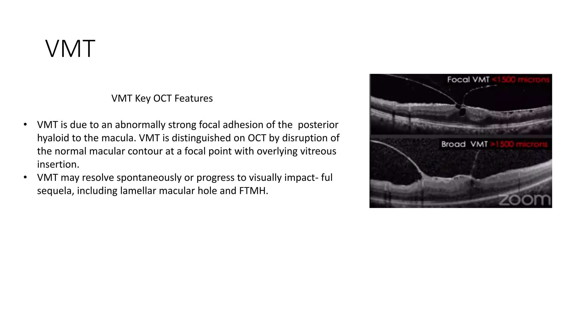 VMT
VMT Key OCT Features
• VMT is due to an abnormally strong focal adhesion of the posterior
hyaloid to the macula. VMT is distinguished on OCT by disruption of
the normal macular contour at a focal point with overlying vitreous
insertion.
• VMT may resolve spontaneously or progress to visually impact- ful
sequela, including lamellar macular hole and FTMH.
 