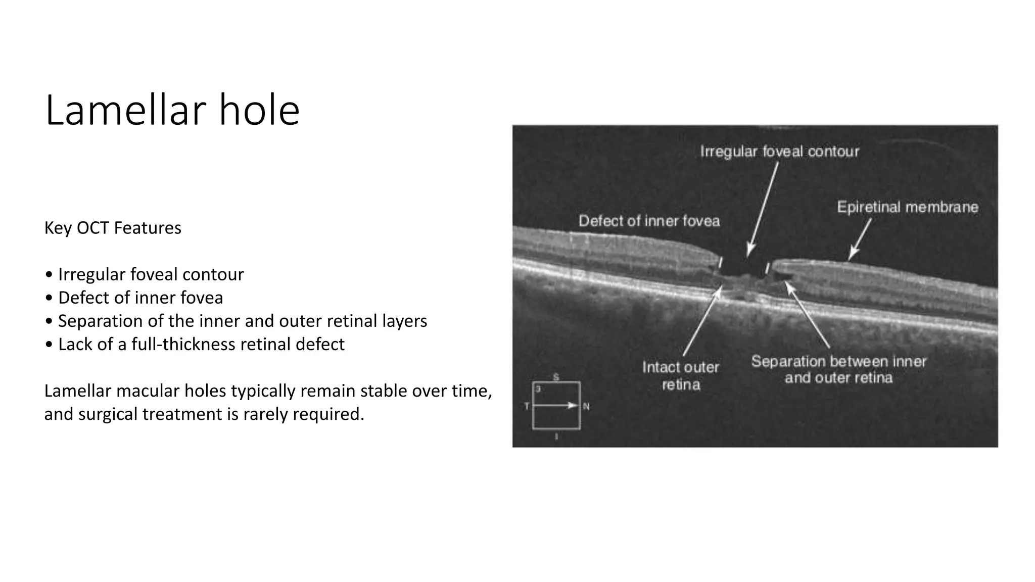 Lamellar hole
Key OCT Features
• Irregular foveal contour
• Defect of inner fovea
• Separation of the inner and outer retinal layers
• Lack of a full-thickness retinal defect
Lamellar macular holes typically remain stable over time,
and surgical treatment is rarely required.
 