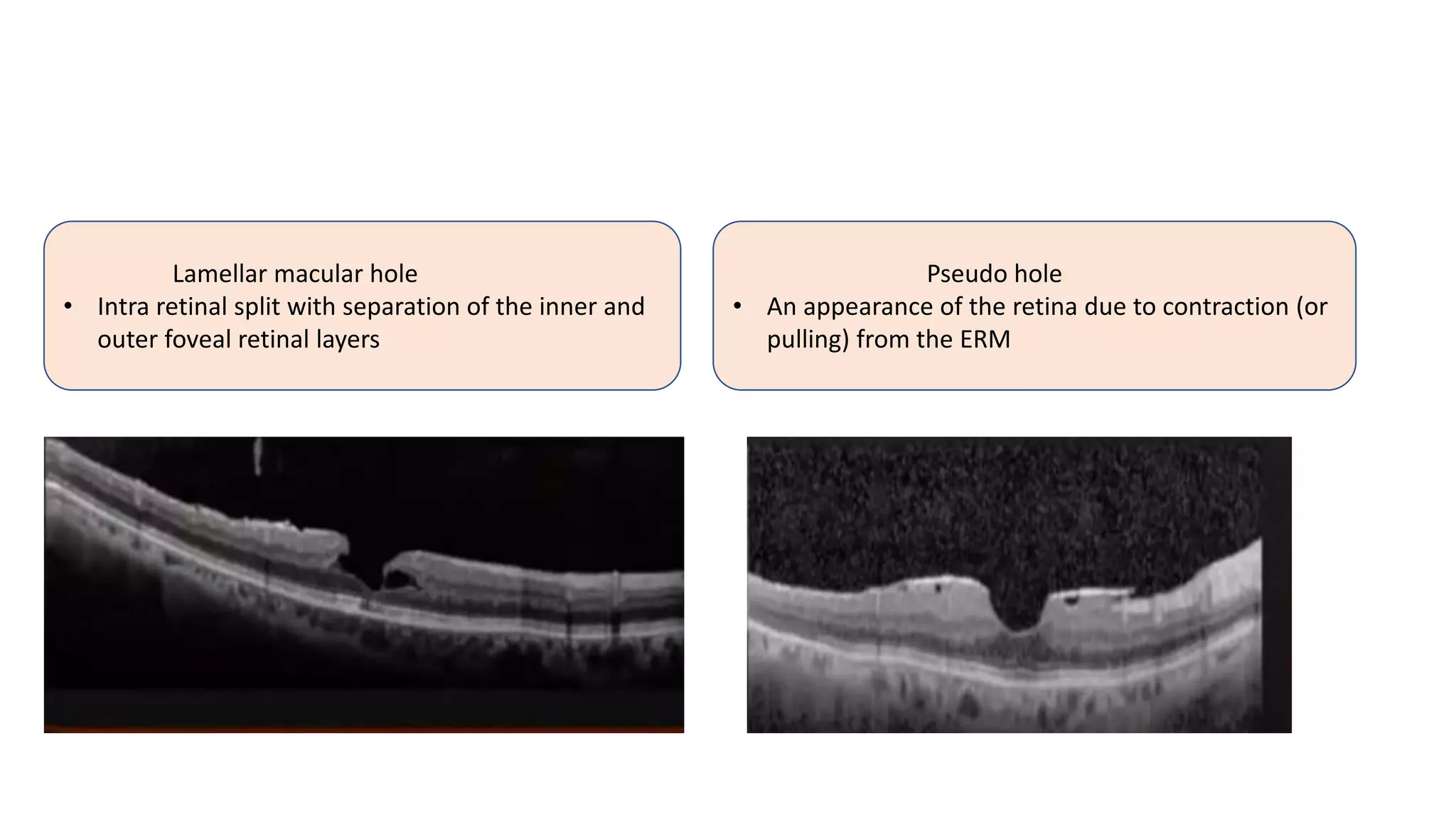 Lamellar macular hole
• Intra retinal split with separation of the inner and
outer foveal retinal layers
Pseudo hole
• An appearance of the retina due to contraction (or
pulling) from the ERM
 