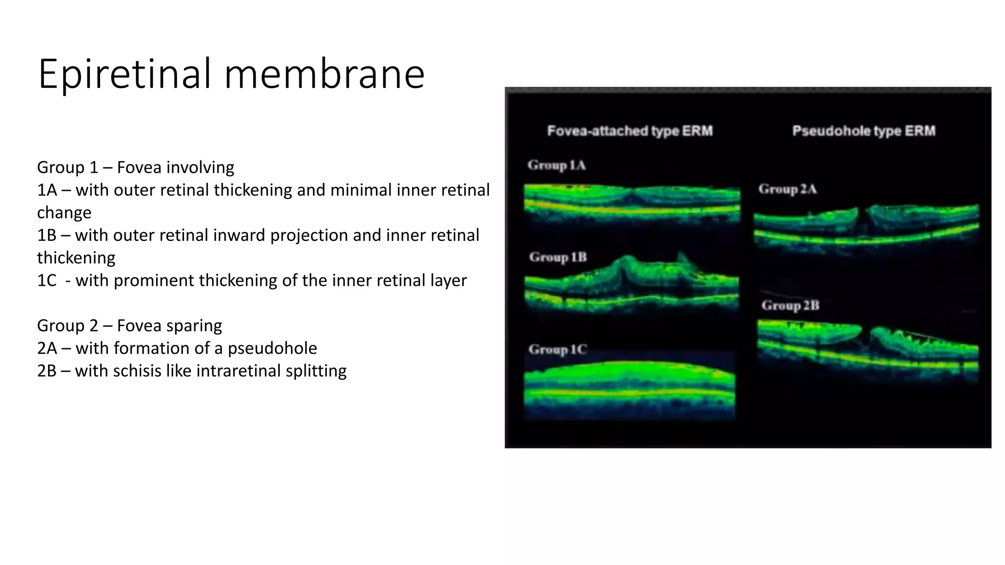 Epiretinal membrane
Group 1 – Fovea involving
1A – with outer retinal thickening and minimal inner retinal
change
1B – with outer retinal inward projection and inner retinal
thickening
1C - with prominent thickening of the inner retinal layer
Group 2 – Fovea sparing
2A – with formation of a pseudohole
2B – with schisis like intraretinal splitting
 