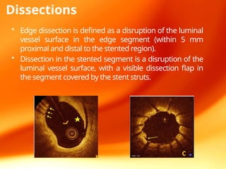 Edge Dissection OCT in intervention cardiology managment.pptx
