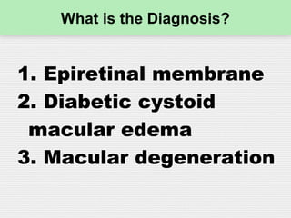 What is the Diagnosis?
1. Epiretinal membrane
2. Diabetic cystoid
macular edema
3. Macular degeneration
 