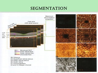 Segmentation
 