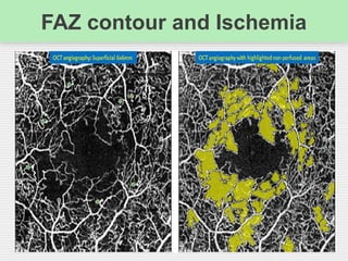 FAZ contour and Ischemia
 