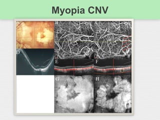 Myopia CNV
 