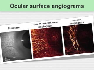 Ocular surface angiograms
 