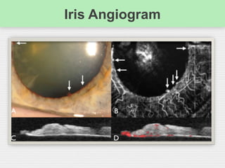 Iris Angiogram
 