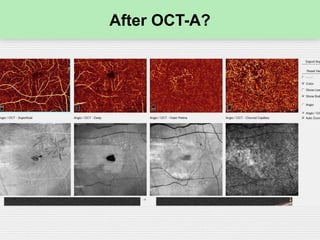 After OCT-A?
 