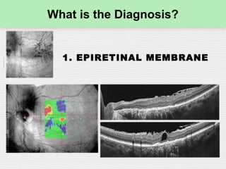 What is the Diagnosis?
1. EPIRETINAL MEMBRANE
 