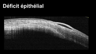 Déficit épithélial 
 