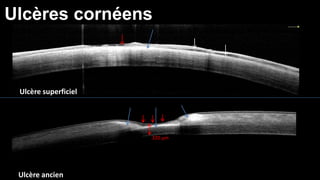 Ulcères cornéens 
Ulcère superficiel 
Ulcère ancien 
320 μm 
 