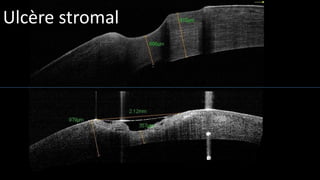 Ulcère stromal 
 
