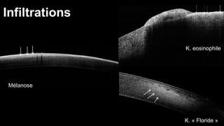 Infiltrations 
Mélanose 
K. eosinophile 
K. « Floride » 
 
