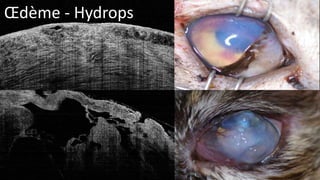 OEdème - Hydrops 
 