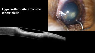 Hyperreflectivité stromale 
cicatricielle 
 