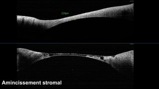 Amincissement stromal 
 